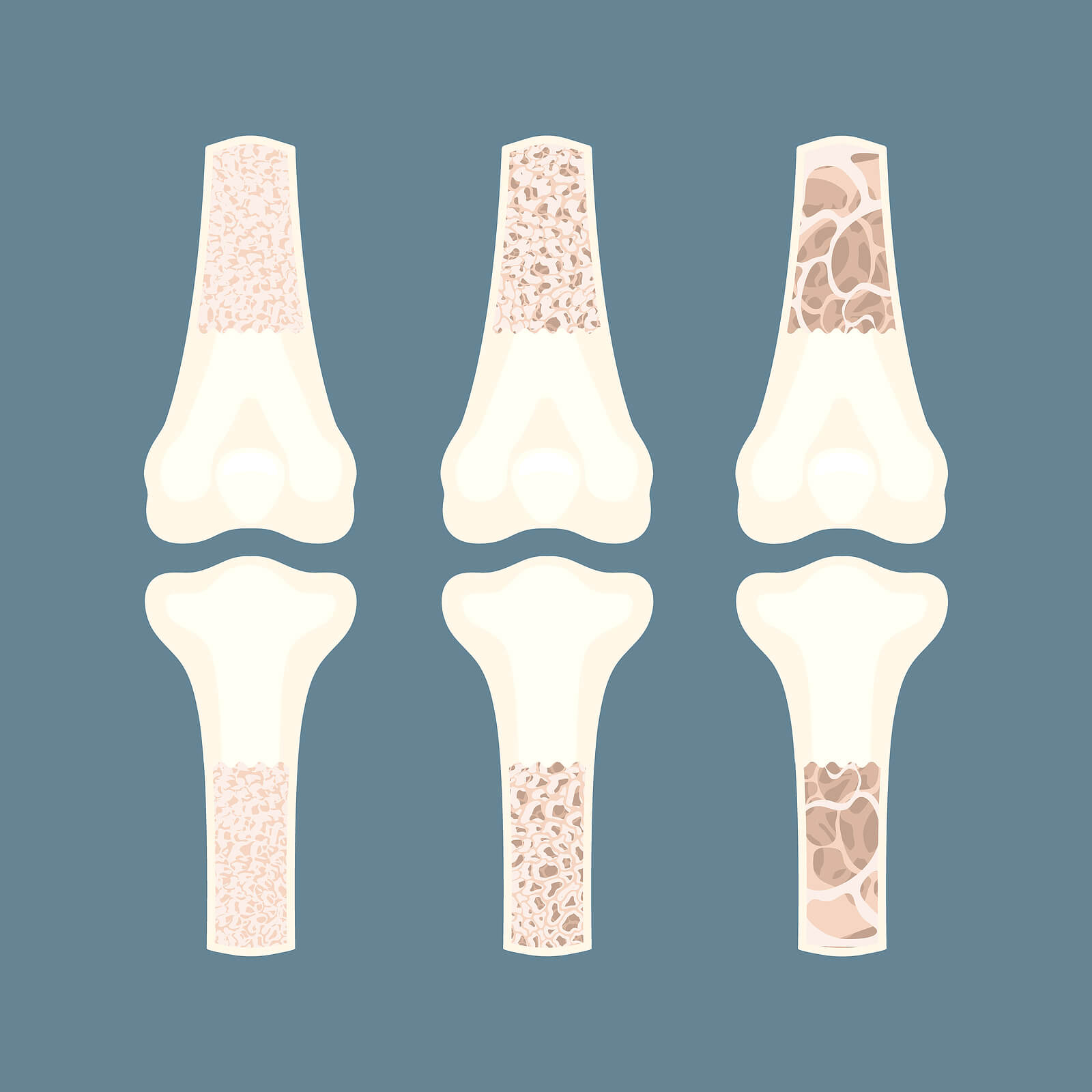 Elder Care in Gulf Shores AL: Bone Loss